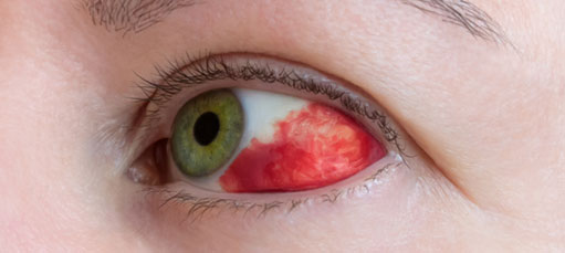 Picture of Subconjunctival Hemorrhage in a patient